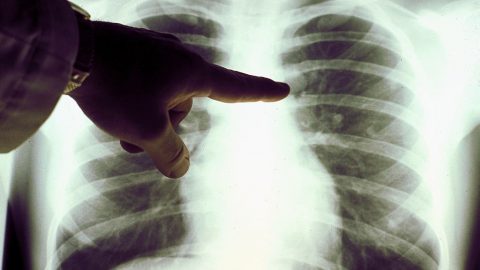 Plicní lékaři znásobí prevenci u kuřáků. Od nového roku doporučí praktici silným kuřákům bezplatný screening plic