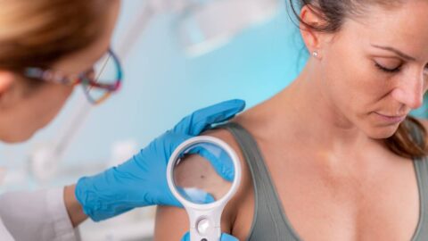 Léto pomalu končí, je čas na kontrolu znamének, doporučují dermatologové