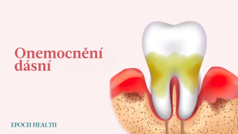 Onemocnění dásní: Příznaky, příčiny, léčba a přírodní postupy