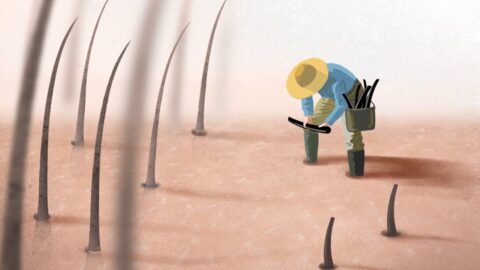 Transplantace vlasů: poslední záchrana, nebo jen klamná naděje?