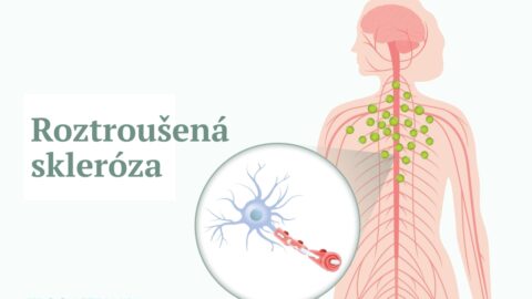 Roztroušená skleróza: příznaky, příčiny, léčba a přírodní přístupy