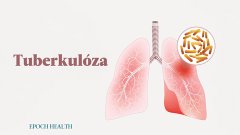 Tuberkulóza: příznaky, příčiny, léčba a přírodní přístupy