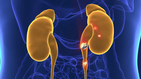 Ledvinové kameny mohou být ve skutečnosti bakteriální kolonie, ukazuje studie