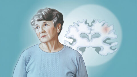 Alzheimerova choroba: Nejčastější neurodegenerativní onemocnění – jaké jsou její příčiny