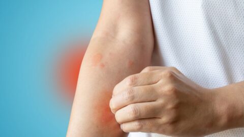 Kopřivka, ekzém a pásový opar: Jak tradiční čínská medicína zmírňuje sezónní kožní problémy