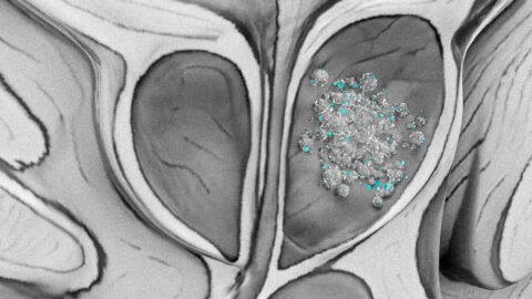 Mikroplasty nalezeny v 9 z 10 vzorků rakoviny prostaty v pilotní studii
