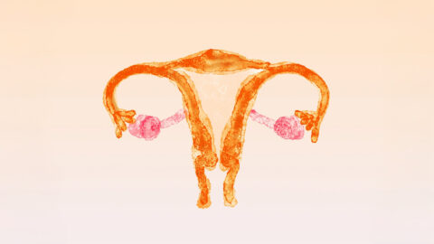 PCOS: Jeden z nejméně pochopených problémů, kterým ženy čelí
