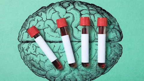 Krevní test dokáže odhalit Alzheimerovu chorobu. Kdo by jej měl podstoupit?